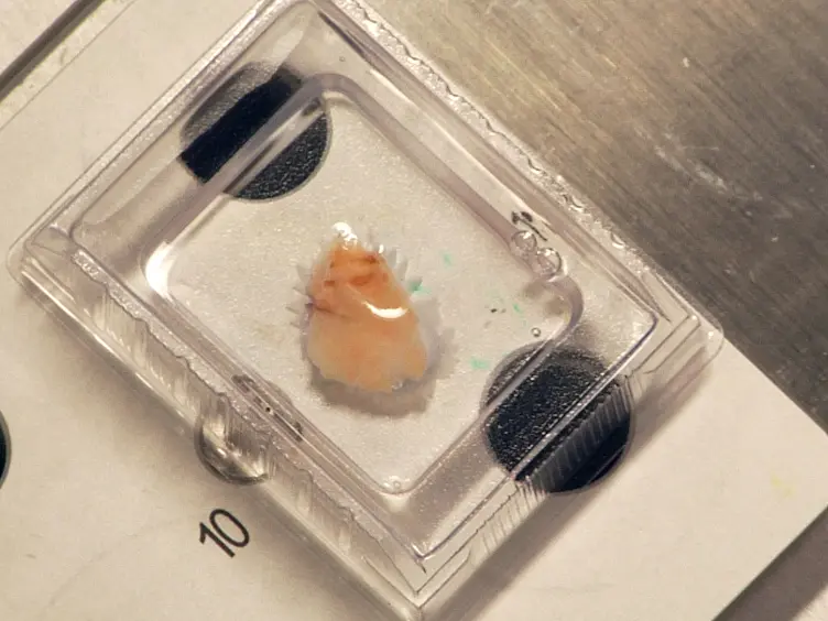 Laser-capture Microdissection of Human Prostatic Epithelium for RNA Analysis
