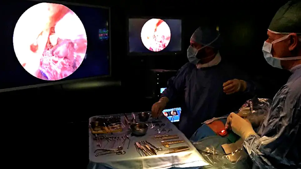 Step-by-Step Stapedotomy through Transcanal Exclusive Endoscopic Approach