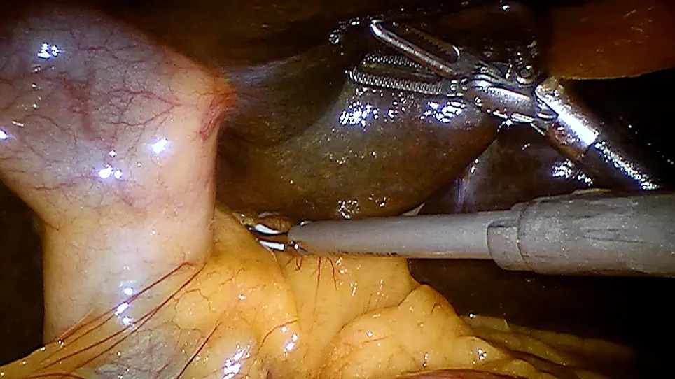Robotic Taj Mahal Hepatectomy for Hilar Cholangiocarcinoma
