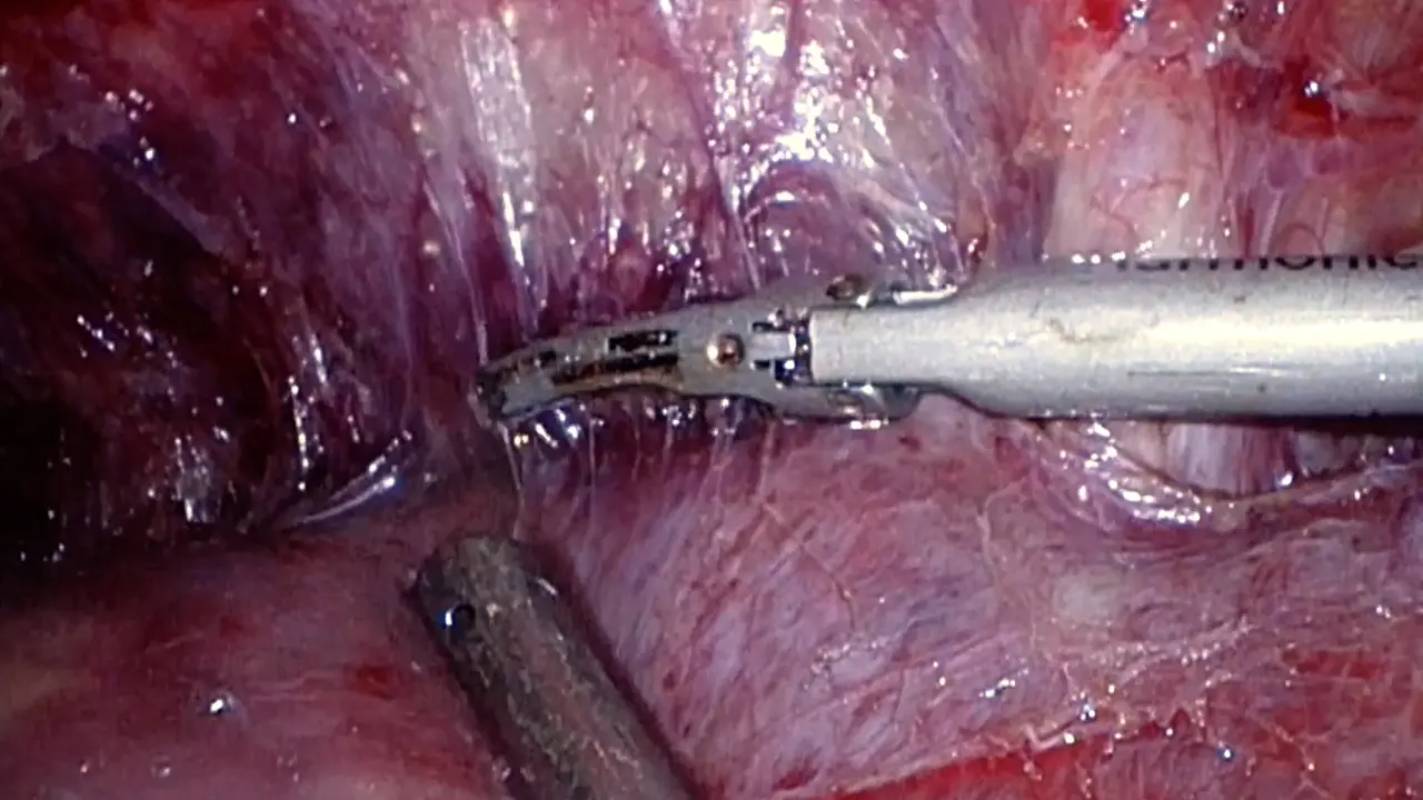 Techniques of Laparoscopic Right Posterior Sectionectomy: Glissonian Approach and a Parenchymal Transection Technique