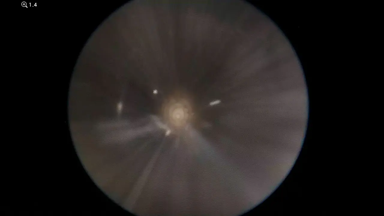 Endoscopic Third Ventriculostomy and Pineal Biopsy from a Single Entry Point