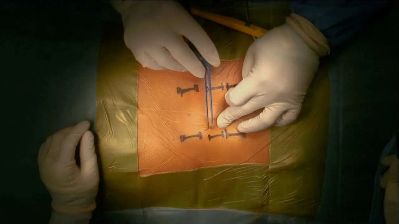 Minimally Invasive Treatment for Thoracolumbar Burst Fracture Using Sagittal Alignment Screws and A Trauma Reduction Device