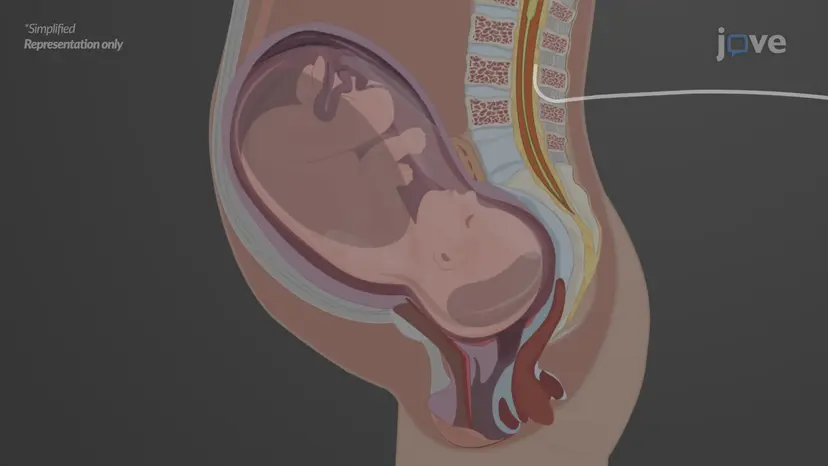 Local Anesthetics: Clinical Application as Epidural Anesthesia