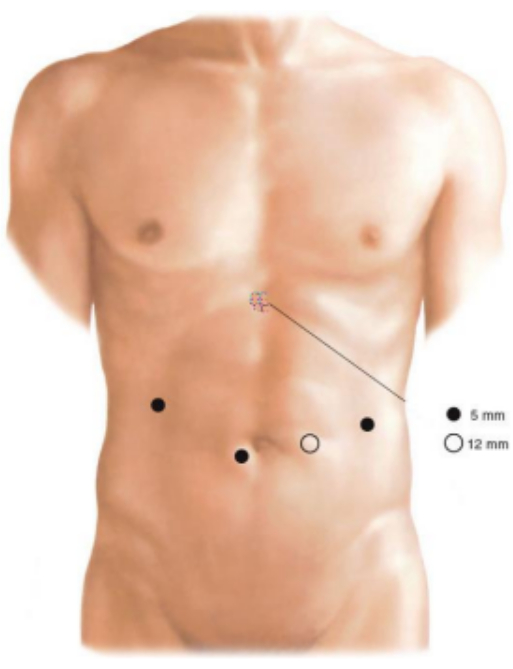 Laparoscopic port sites on abdomen; surgical procedure diagram; minimally invasive surgery.